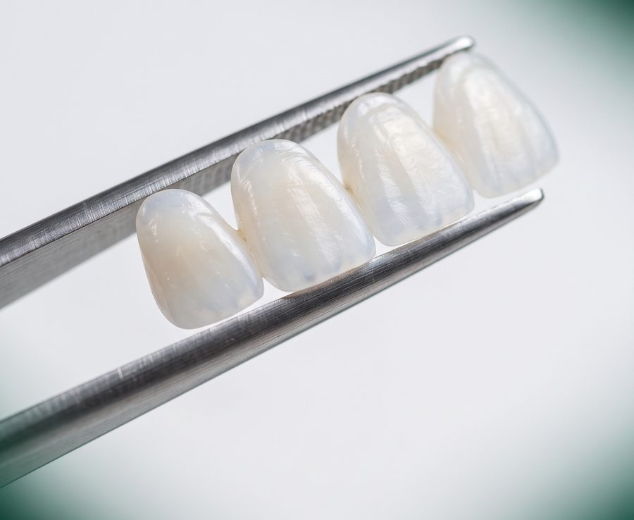 Fațete dentare ceramice emax la Bel-Dent Baia Mare